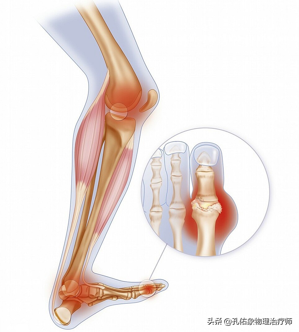 痛風發作時,最常侵犯拇指關節和大腳趾關節,其次比較常見的是腳踝,腳