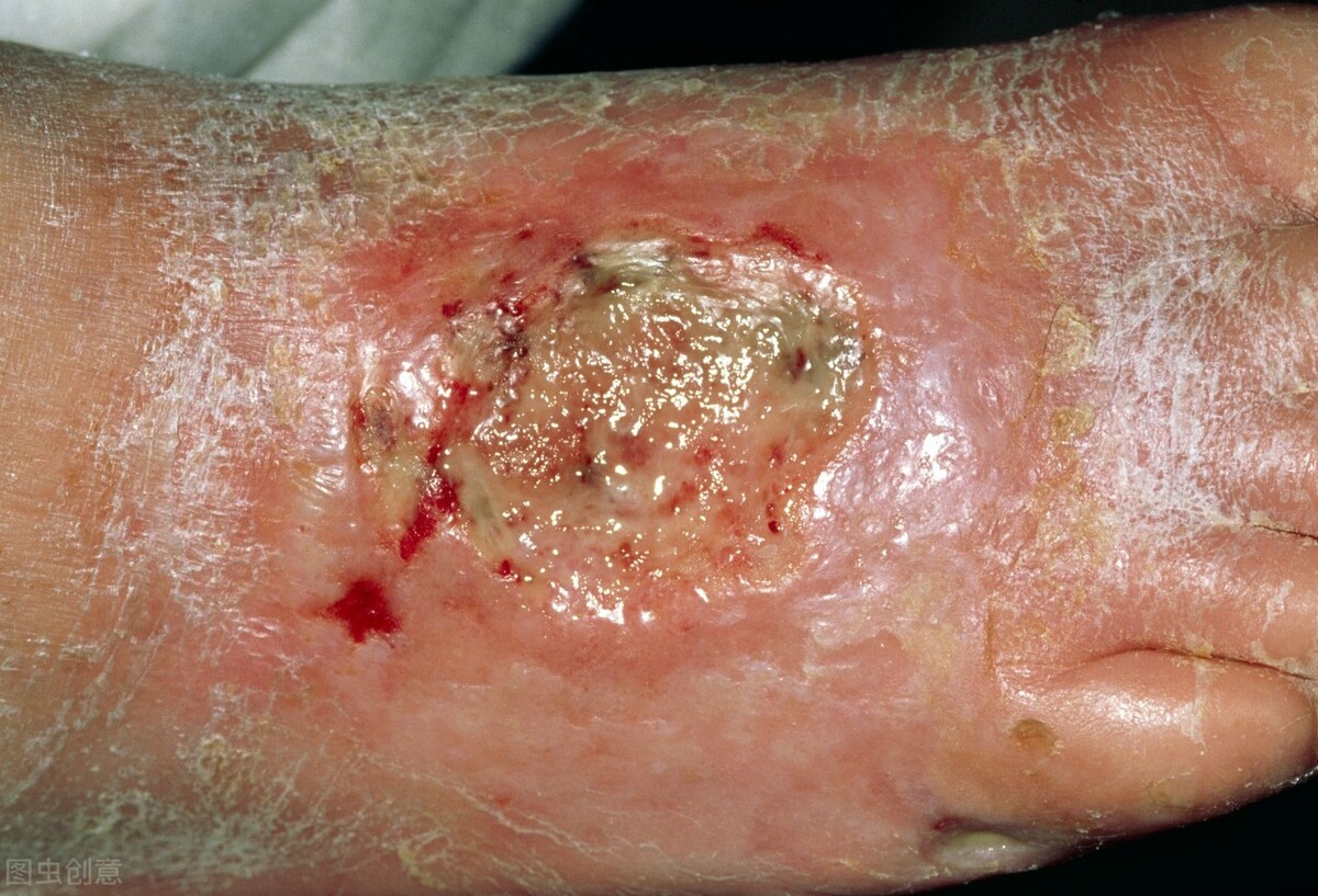 盘点古代为别人"吮脓""舐痔"的人们,口味儿稍重