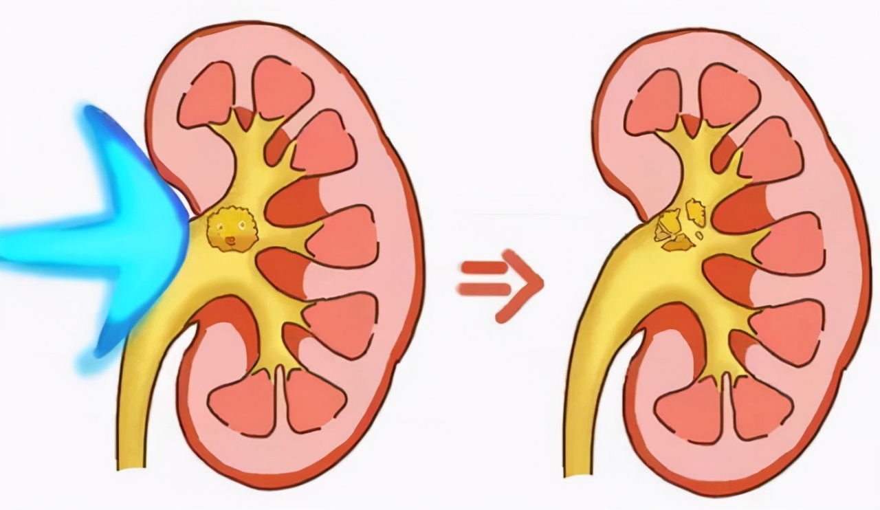 肾结石“体外碎石”并非“万能”，它的这些副作用你知道吗？