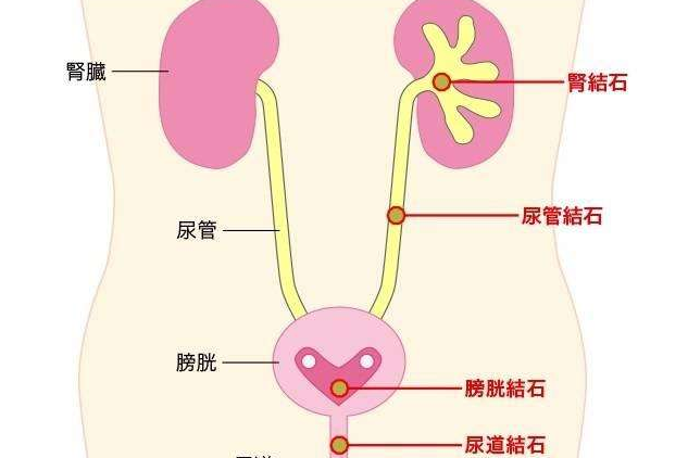 泌尿系统结石，解说体外冲击波碎石术的适应症和禁忌症