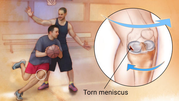 经常打篮球对膝盖有损伤吗(如果您年届四十，热爱篮球运动，但只要打篮球就膝盖疼，请看此文)