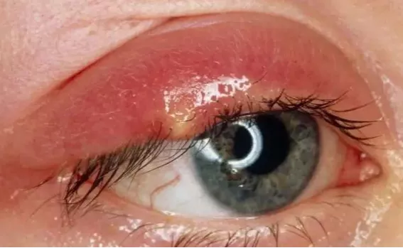 【爱眼护眼96】长了"针眼"怎么办