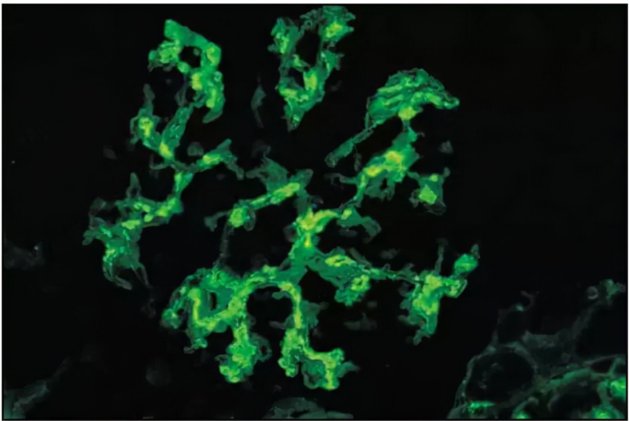 IgA肾病——与免疫密切相关的肾脏病「免疫相关肾脏科普35」