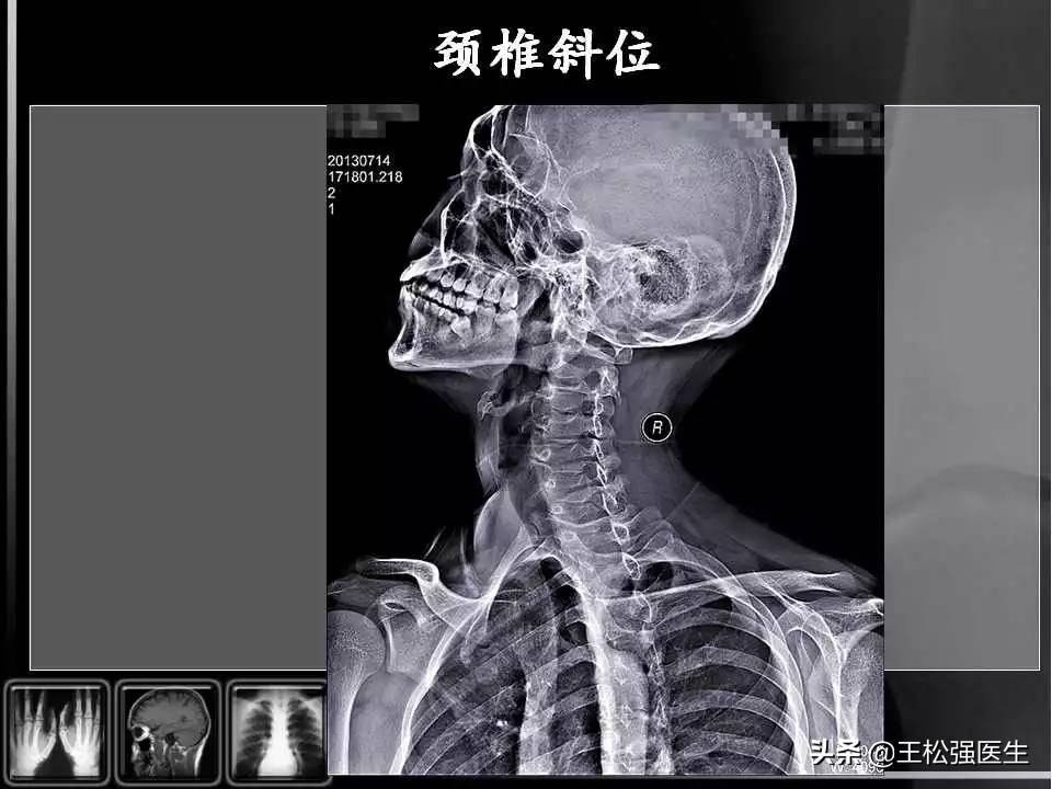 颈椎X光片
