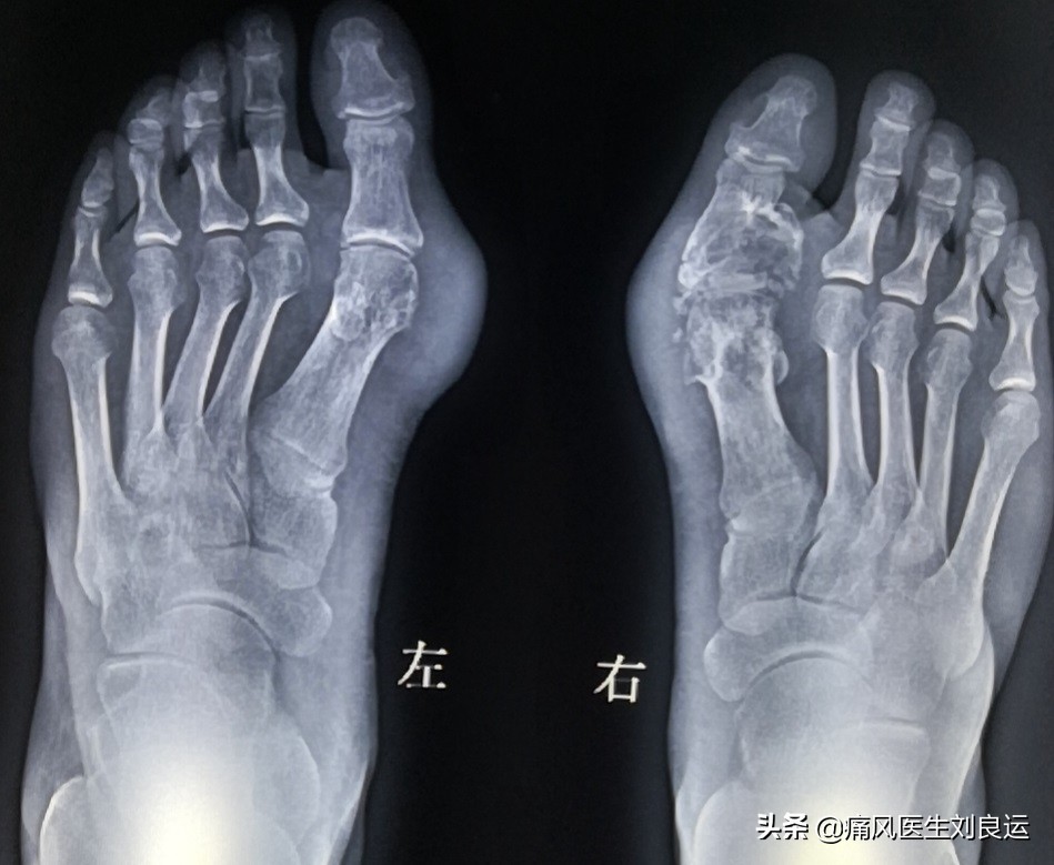 痛风急性发作只会在大脚趾上？不，手脚等四肢关节都可能发作