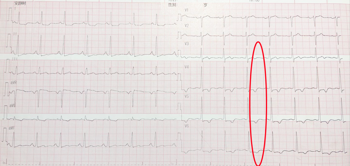 心電圖t波改變是怎麼回事兒?就是冠心病嗎?