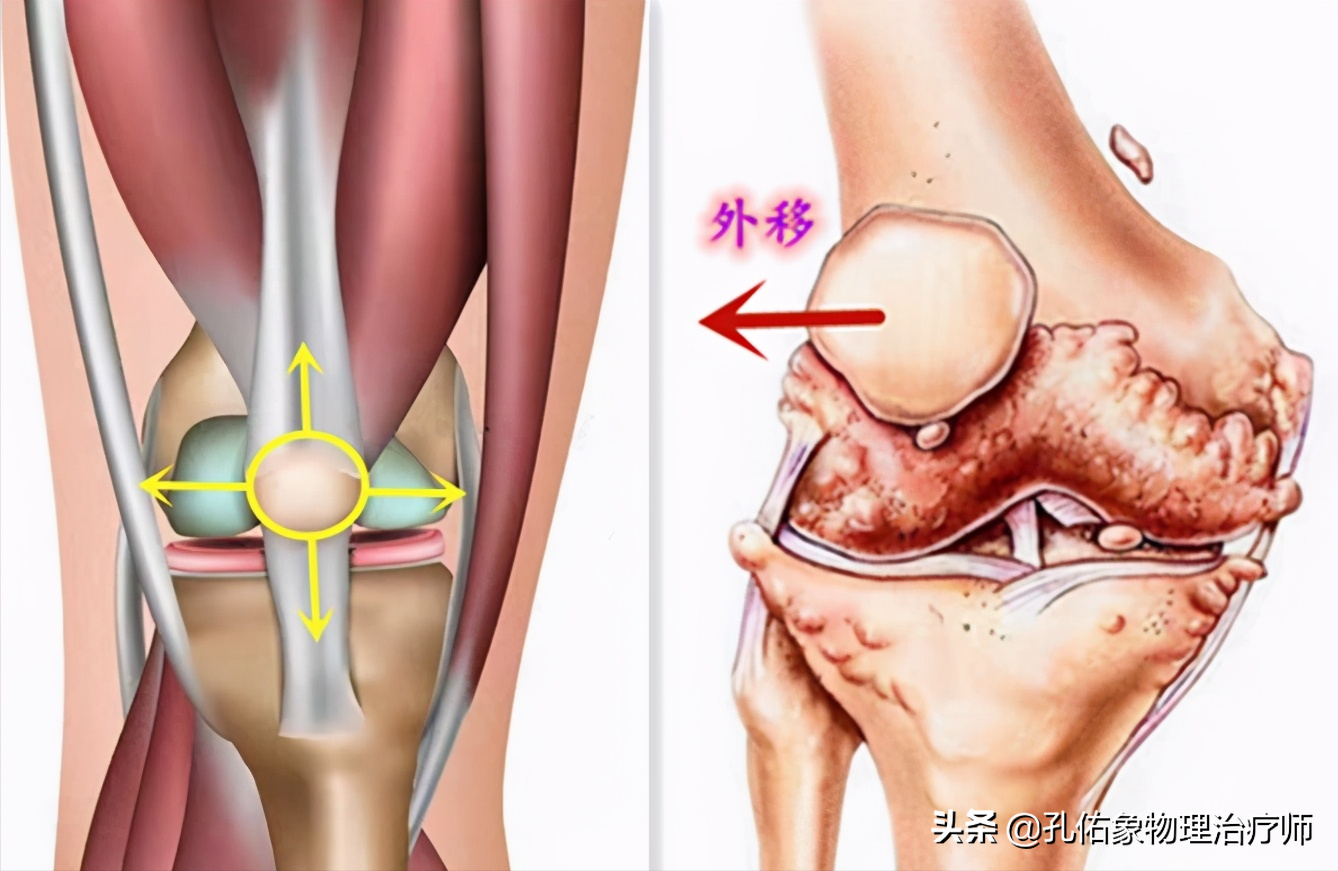 膝关节疼痛的元凶是什么？骨性关节炎吗？要如何应对？请看此文