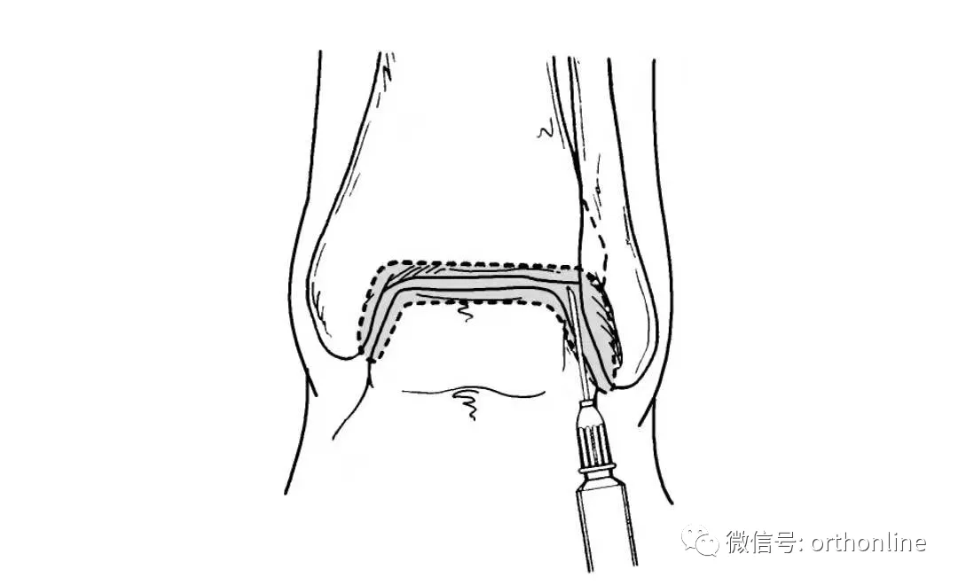 临床实用 | 关节穿刺技术分享