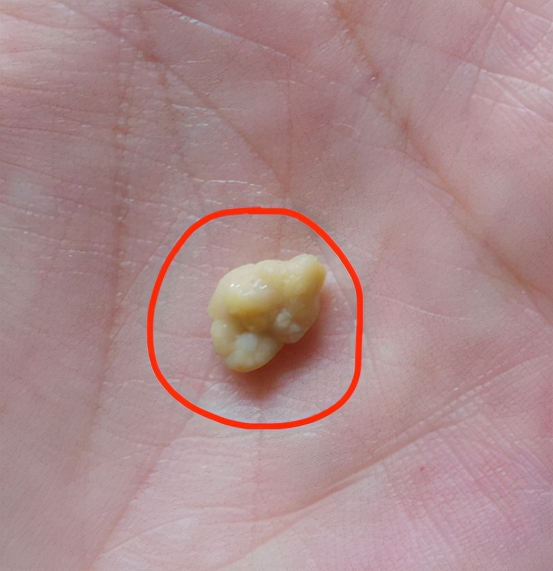 扁桃体结石|不规则的小颗粒,非常臭,还忍不住想闻?本文说清楚