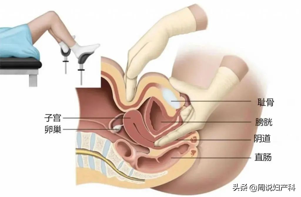 宫颈癌筛查该咋选？TCT和HPV哪个好？