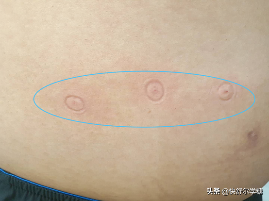 对于接受胰岛素治疗的糖尿病人来说，哪个牌子的无针注射器更好用