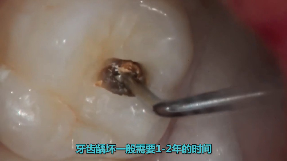 蛀牙初期图片儿童（图文讲解蛀牙的初期样子）