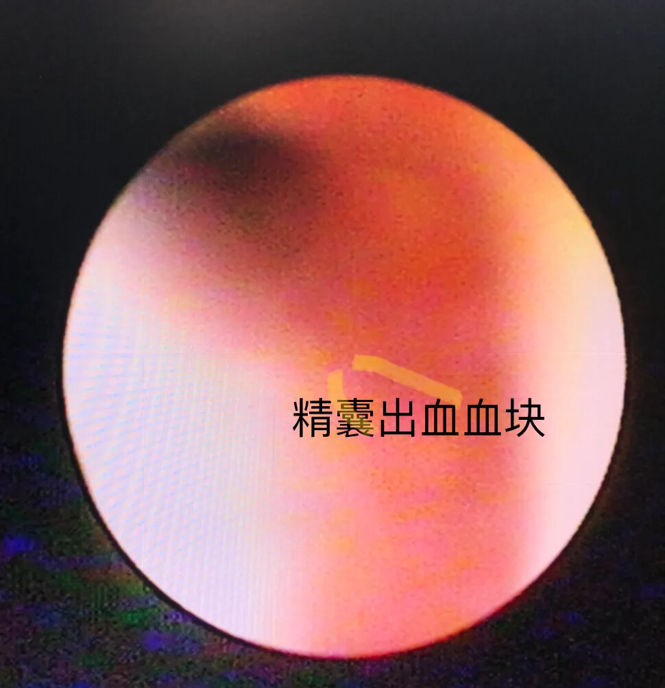男科手术探秘6:精囊炎血精、精囊结石和精囊镜手术、钬激光碎石