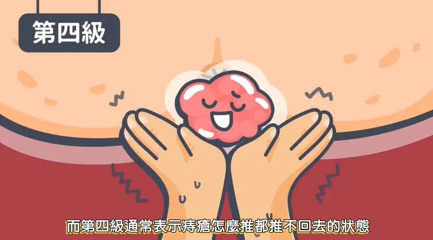 便秘+痔疮,千万别自行用药,当心越用越糟