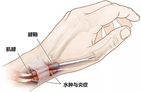 腱鞘炎成因及治疗方法详解