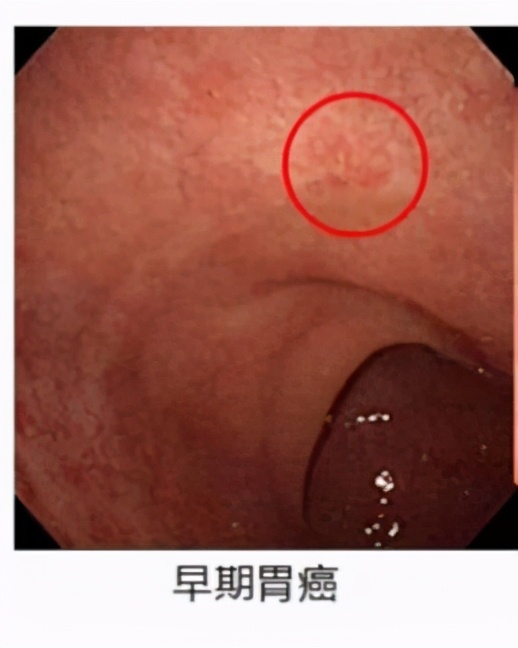 95%的体检都查不出癌症：癌症早筛是真有用，还是智商税？