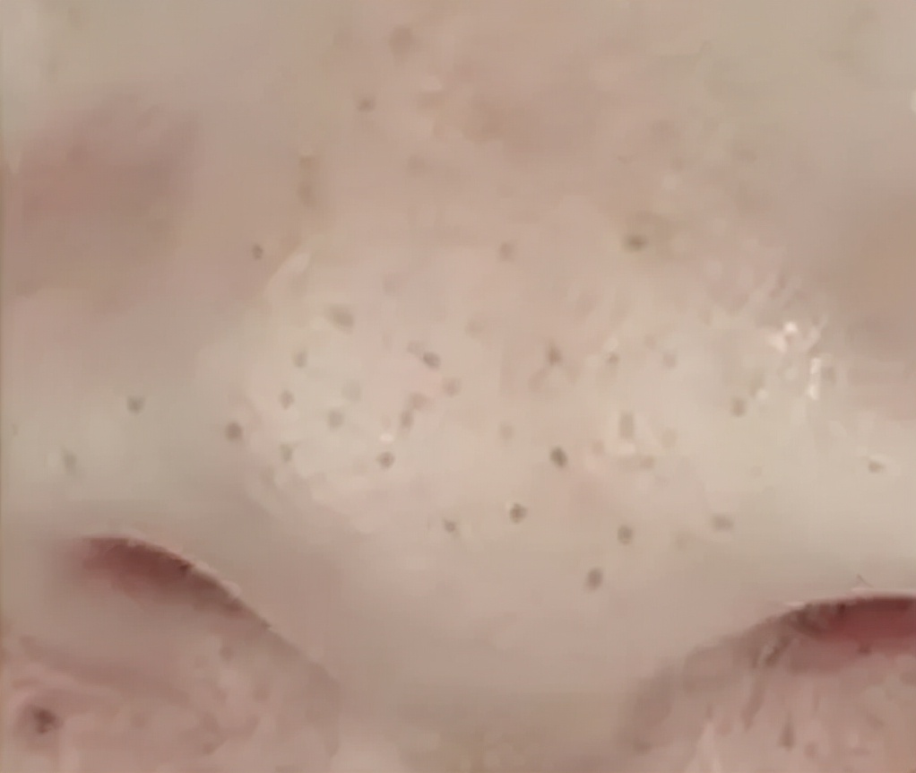 你鼻子上的真的是黑头吗？教你正确祛黑头
