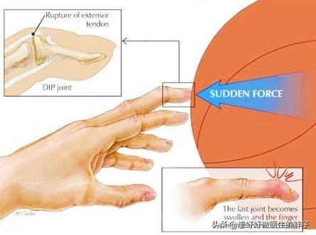 打排球戳到大拇指了会不会伤到筋(手指打篮球挫伤了，半年不恢复，还肿着，听听医生给您的治疗建议)