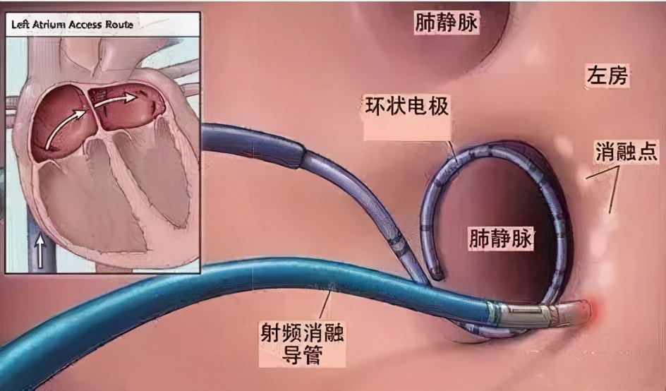 射频消融术让房颤患者重获“心”声