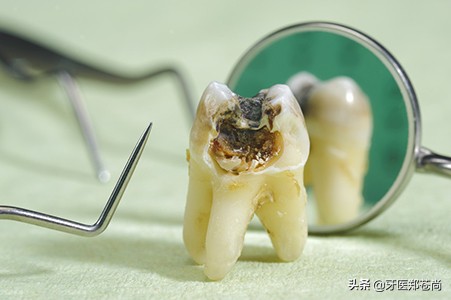 蛀牙可以直接拔掉吗？患者有两颗重度蛀牙