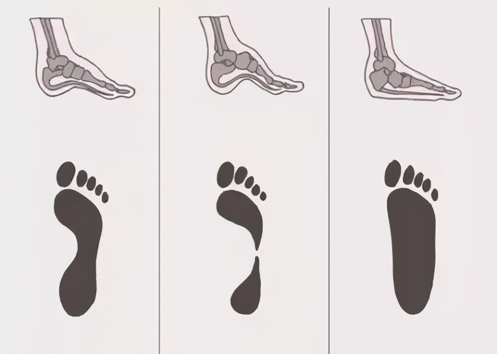 足弓垫瘦腿怎么使用（萝卜腿，可能是因为扁平足！教你一招建立足弓瘦小腿）