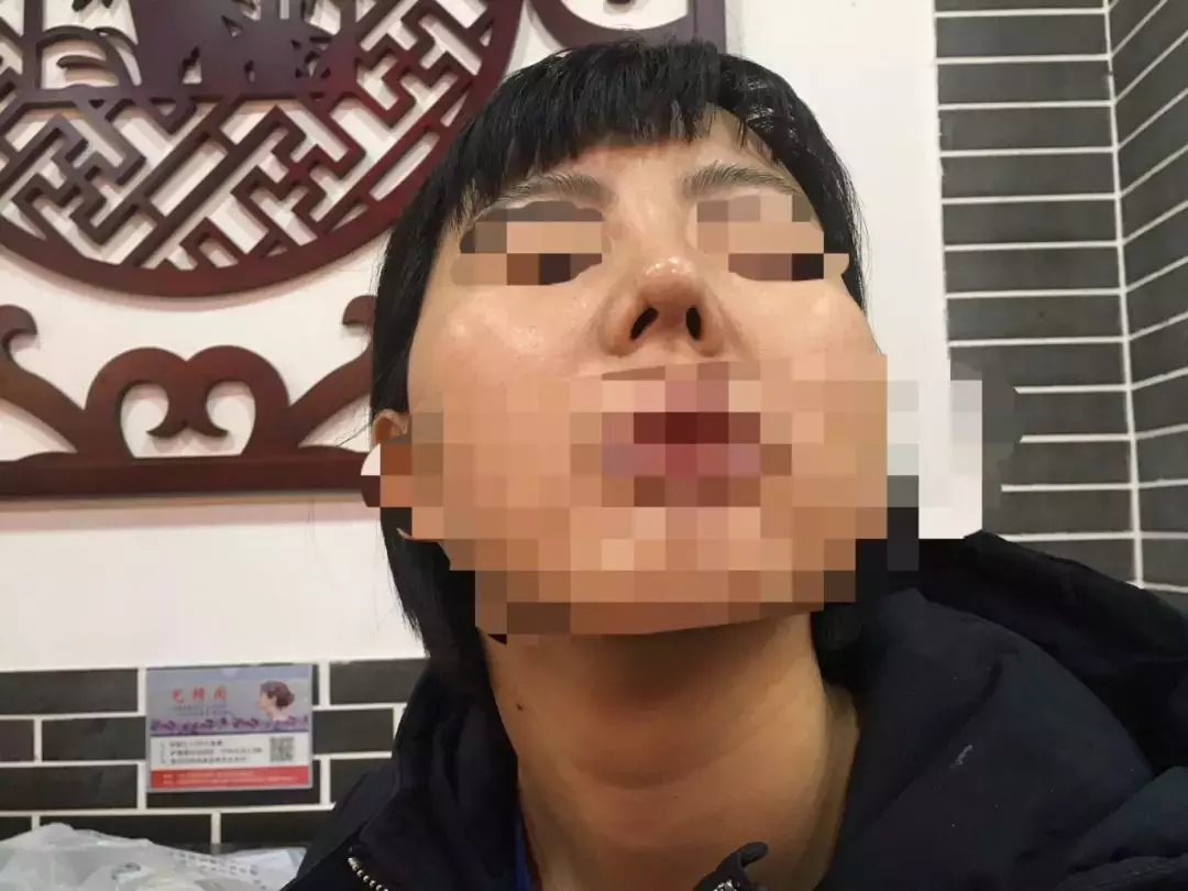 女子花1万7隆鼻,隆完鼻子歪了!美容机构:给你免费修