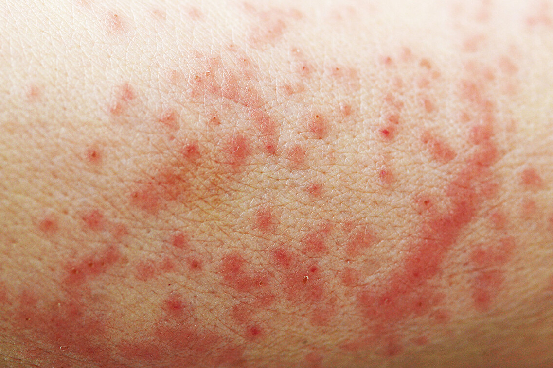 胳膊长了小红点不痛不痒(胳膊长了小红点不痛不痒压之褪色)-友友