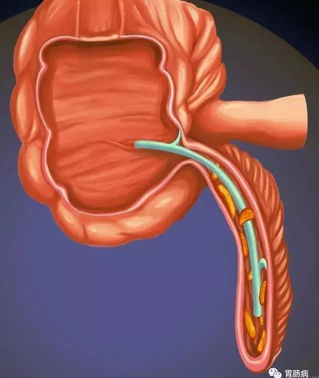 不开刀也能治疗阑尾炎,这种疗法值得推荐——内镜下erat术