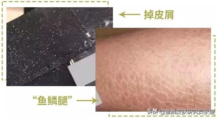 一到九、十月份，皮肤就干燥脱皮，鱼鳞病患者秋季该怎么办？