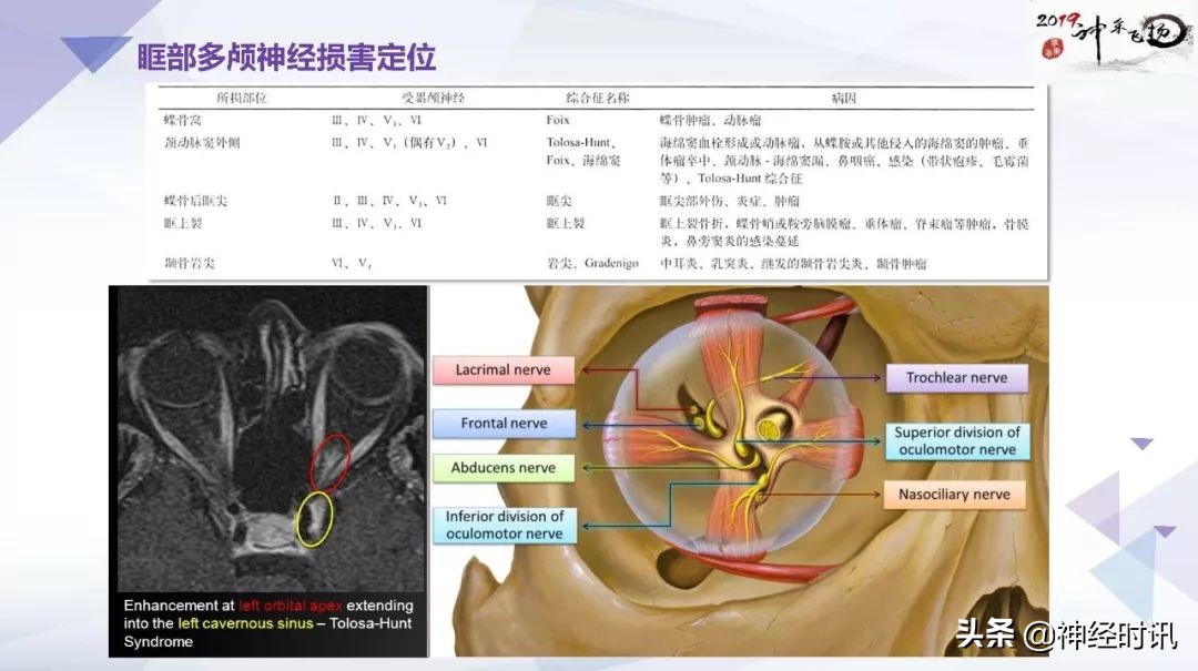 解剖&影像 | 颅神经的解剖基础和临床定位