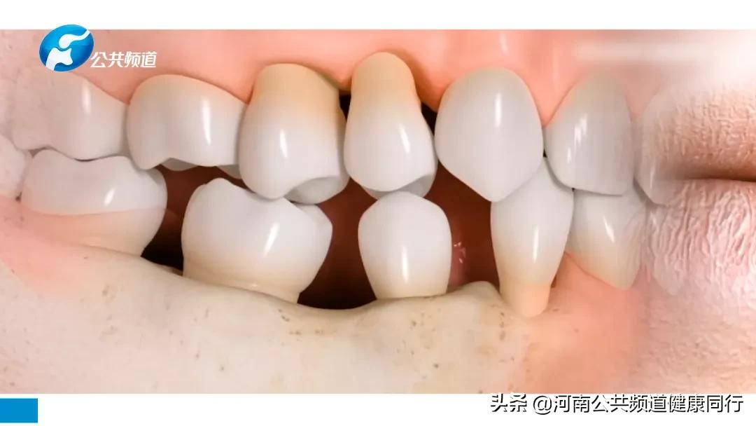 关注口腔 爱在植得 | 高昂:牙齿缺失影响全身健康,特别是老年人,不可忽视