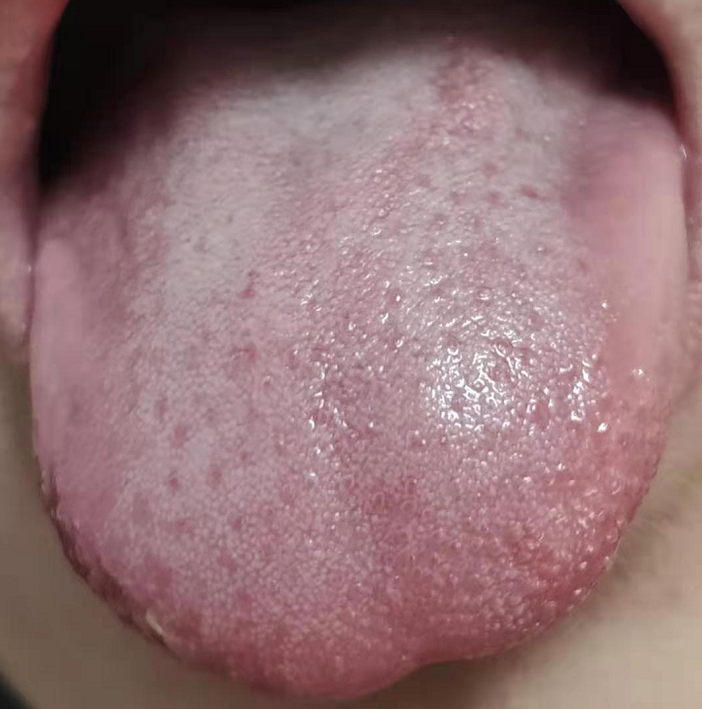 风寒感冒——舌苔白润在联想下四面白茫茫的冰雪,很白,所以鼻水是清的