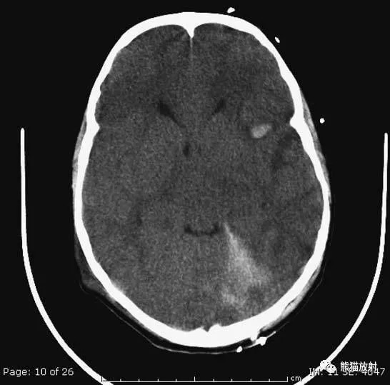 简明又详细的头部CT读片详解，收藏
