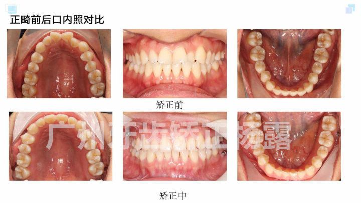 广州牙齿矫正杨露隐适美隐形矫正戴牙套全案例