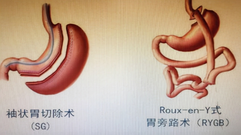 21岁男子“切胃”记录：切掉80%的胃，术后一天吐5次，后遗症多多
