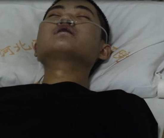 23岁男子百草枯中毒记录:抢救27天,最终无法呼吸,窒息而死