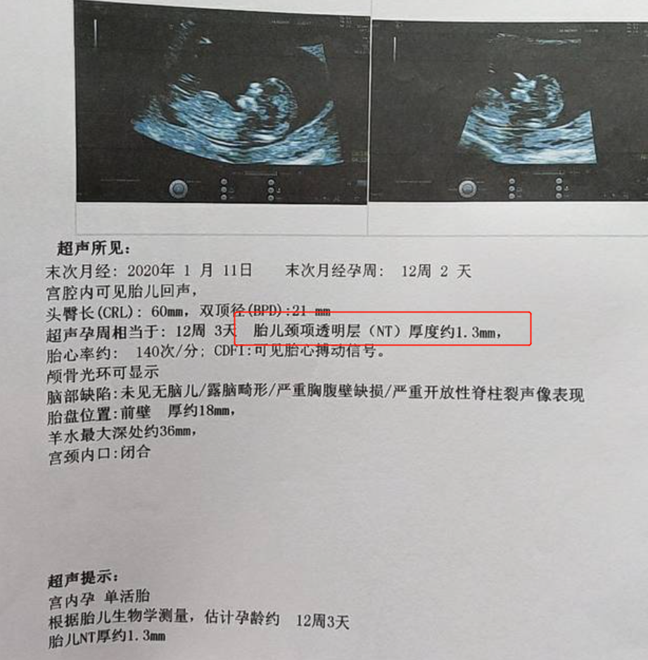 怀胎十月检查必不可少，5次常规B超的常识，每个妈妈都应该清楚