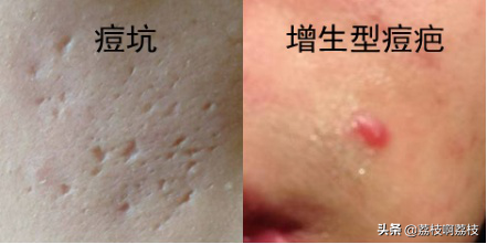 掏了室友脸上一颗大黑头，留了一个大洞，该怎么办？