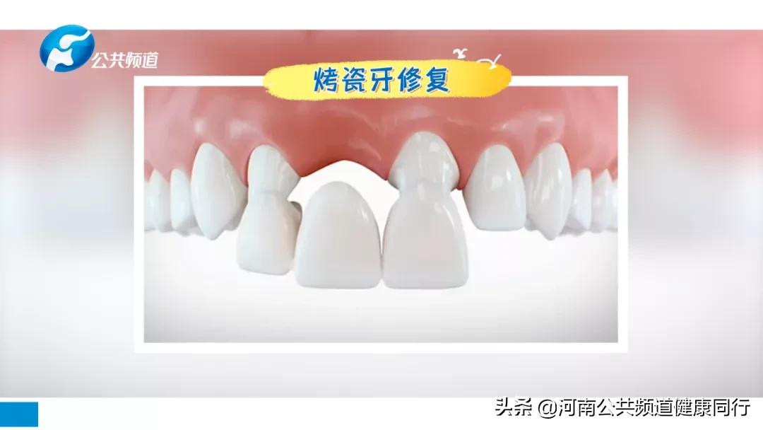 关注口腔 爱在植得 | 高昂:牙齿缺失影响全身健康,特别是老年人,不可忽视