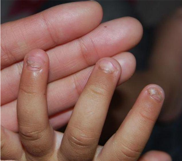 孩子咬指甲总咬出血?并非缺维生素这么简单,这4个原因是关键