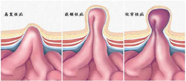 疝气手术那些事