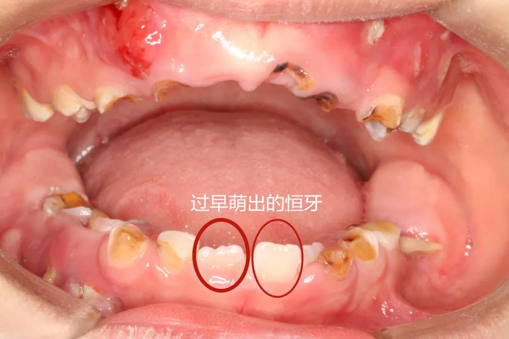 乳牙龋齿要注意，放任不管影响面部发育，别因侥幸毁了孩子一口牙