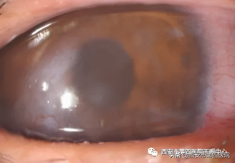 #健康中国行动2030# 总是眼痒、眼干、流泪？三种治疗方式来了解！