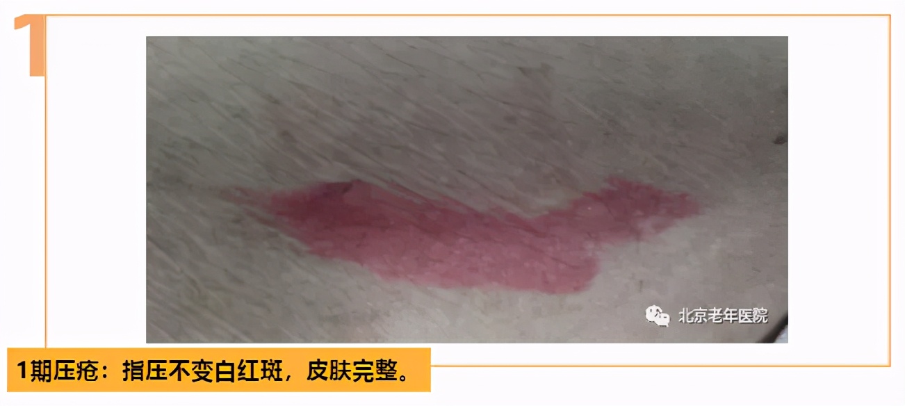 居家照护者如何识别早期压疮？