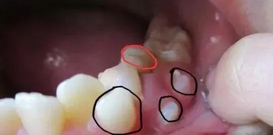 宝宝牙齿钙化轻度图片(omg) - 赤虎壹号