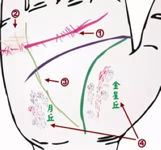 掌纹诊病：可以诊断肝癌、糖尿病、高血压、妇科病、脑溢血