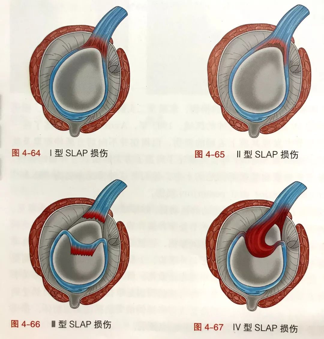 打羽毛球手臂肌肉拉伤怎么办(爱打羽毛球、推杠铃的人注意了！一旦肩关节SLAP损伤大部分要手术)