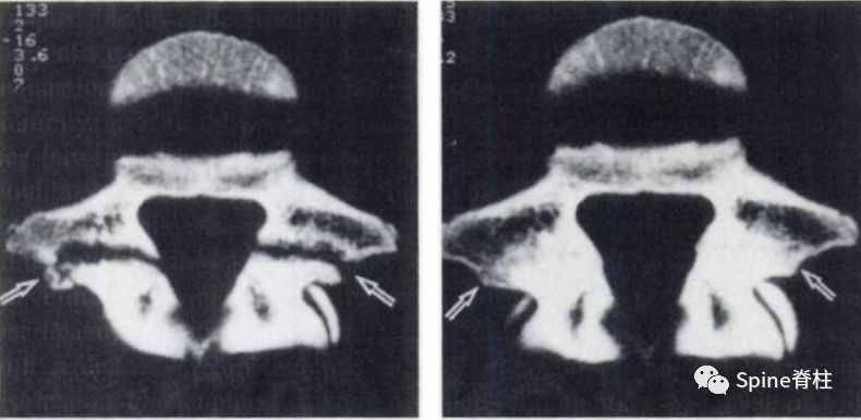 从诊断到治疗：全面解析腰椎峡部裂(lumbar spondylolysis)