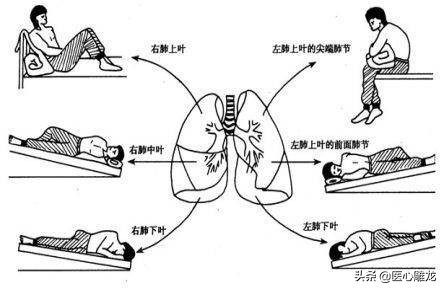 支气管扩张反复发作，咳痰不尽怎么办？这3种方法可以让痰排出