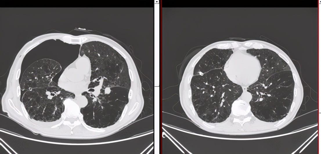 74岁老人气胸久治不愈，打算回家等死，医生仔细观察CT后：等一下